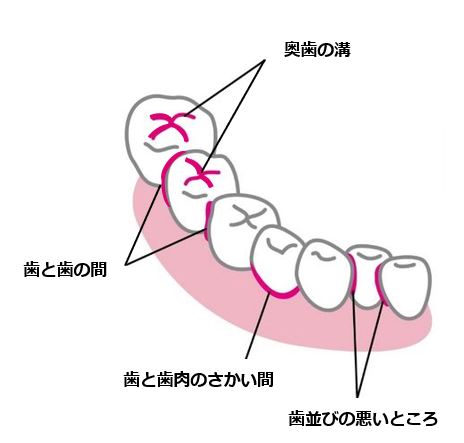 歯のイラスト：奥歯の溝、歯と歯の間、歯と歯肉のさかい目、歯並びの悪いところ